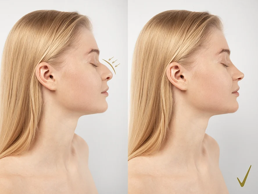 Nose Reduction Surgery Large Nose Turkey — Prof. Dr. H. Baki Yılmaz
